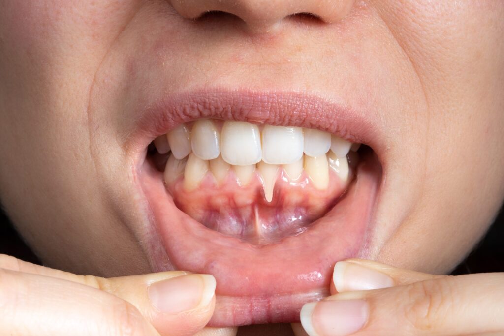 Preparing for teeth whitening with receding gums England